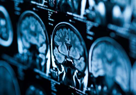 Brain Injuries
